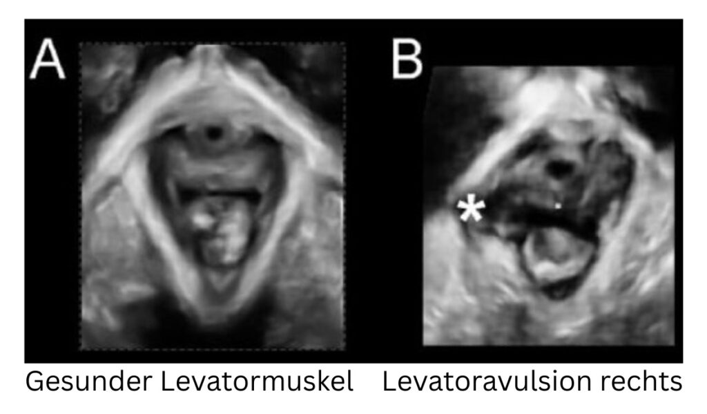 Levatoravulsion/Levatorabriss: Die Beckenbodenverletzung nach der Geburt, über die niemand spricht 1 Levatoravulsion/Levatorabriss im Ultraschall
