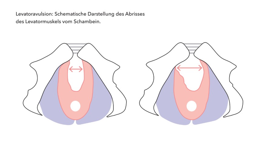 Levatoravulsion/Levatorabriss: Die Beckenbodenverletzung nach der Geburt, über die niemand spricht 2 Grafische Darstellung Levatorabriss